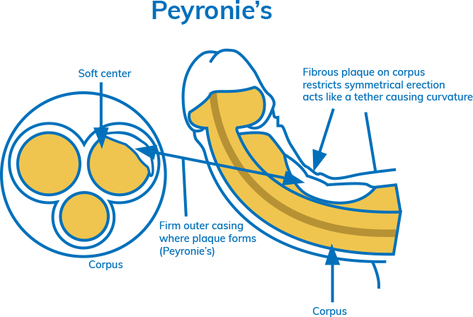 Diamgram: Peyronie's Disease